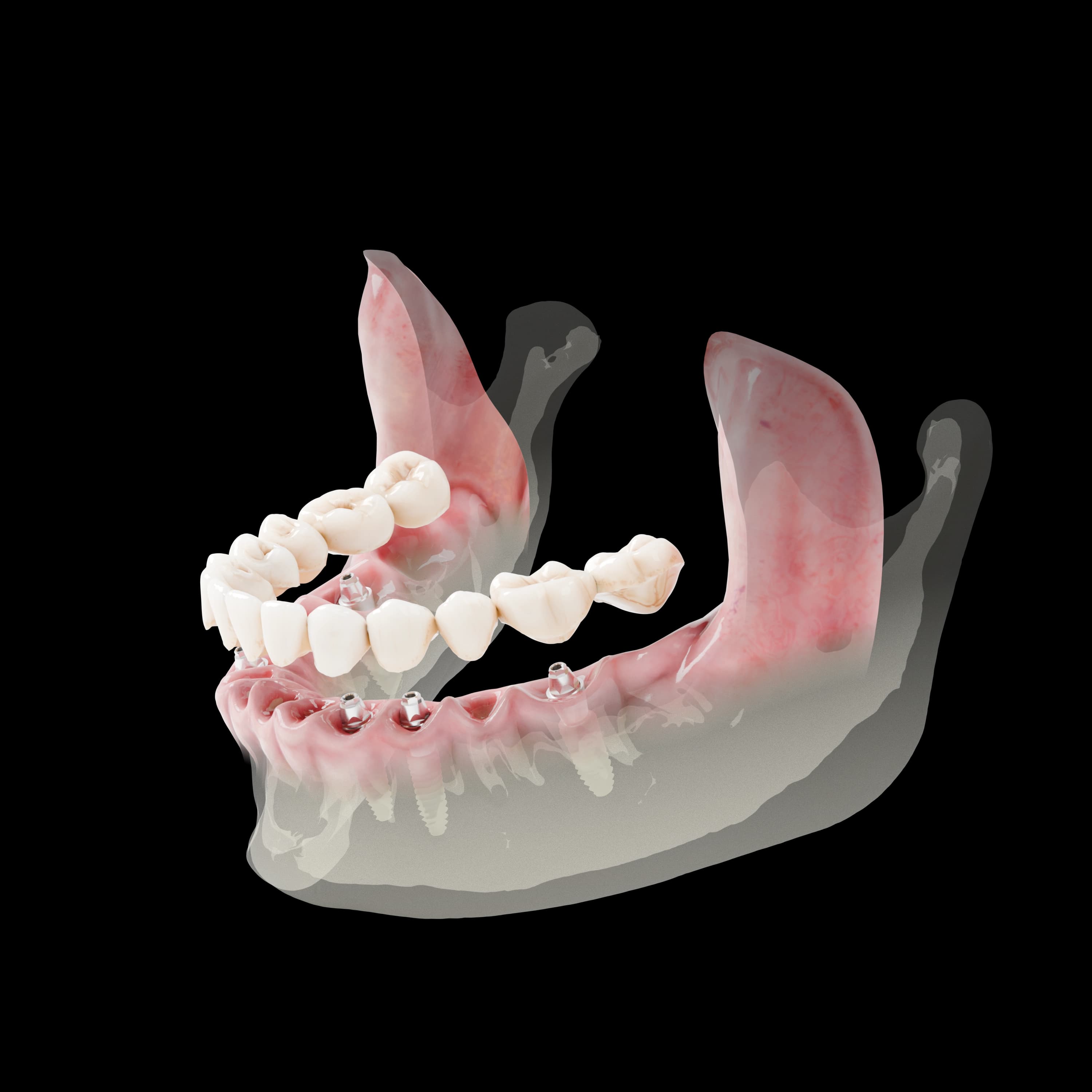 DIO NAVI Full Arch — dijital tam çene çözümü